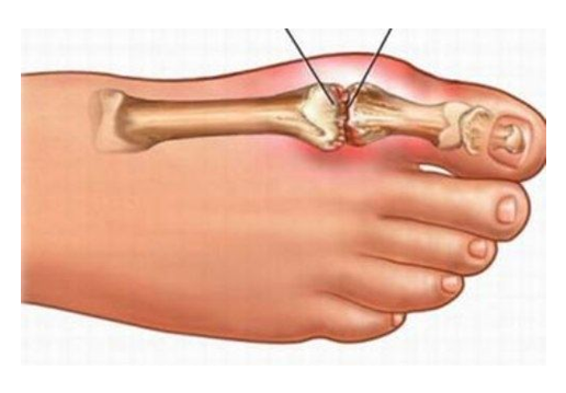 Triệu chứng bị bệnh gút